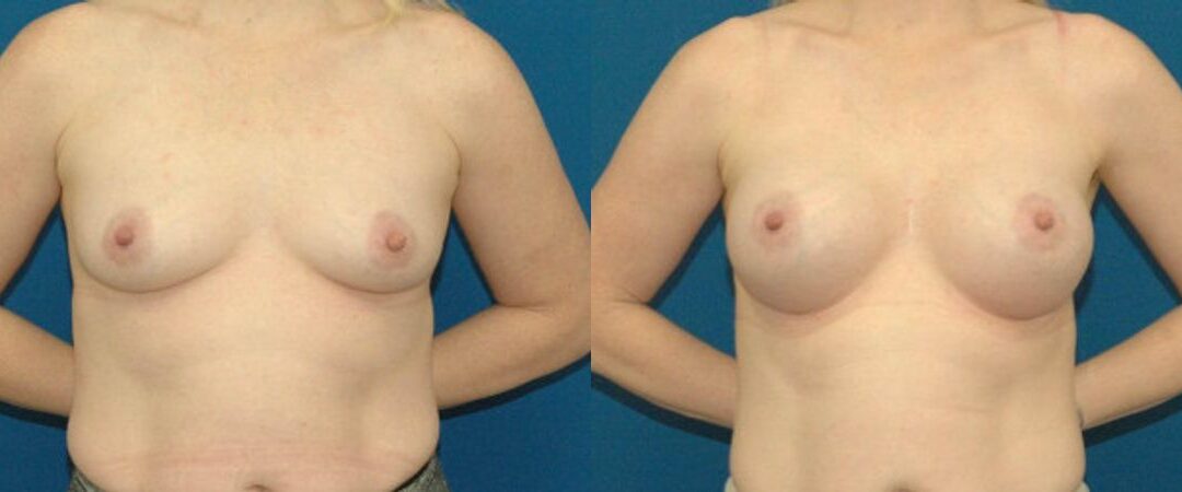 Breast Implant #78