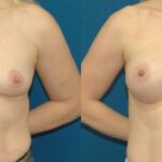 Breast Implant #78 - Before and After