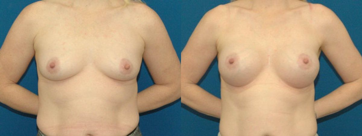 Breast Implant #78 - Before and After