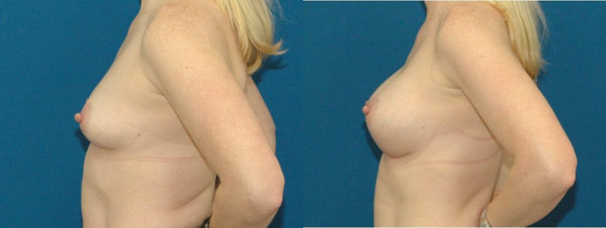 Breast Implant #78 - Before and After