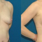 Breast Implant #78 - Before and After