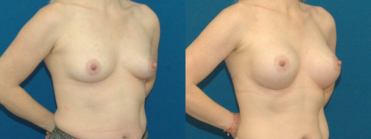 Breast Implant #78 - Before and After