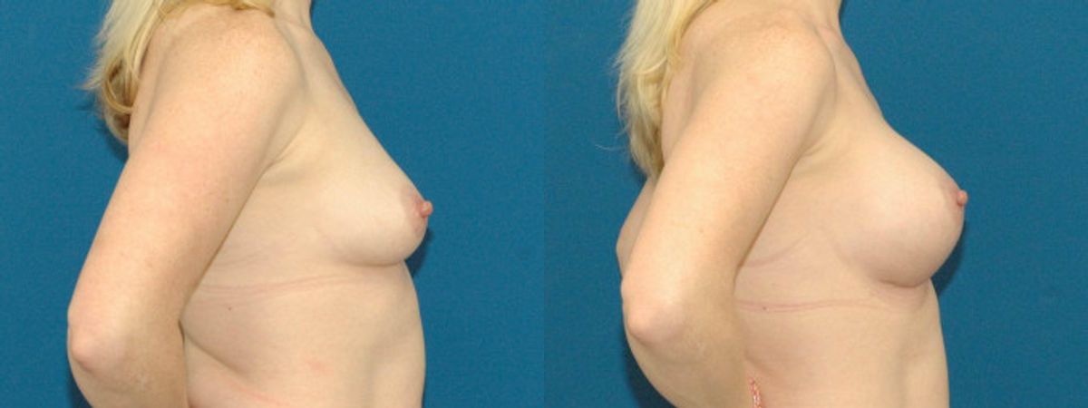 Breast Implant #78 - Before and After
