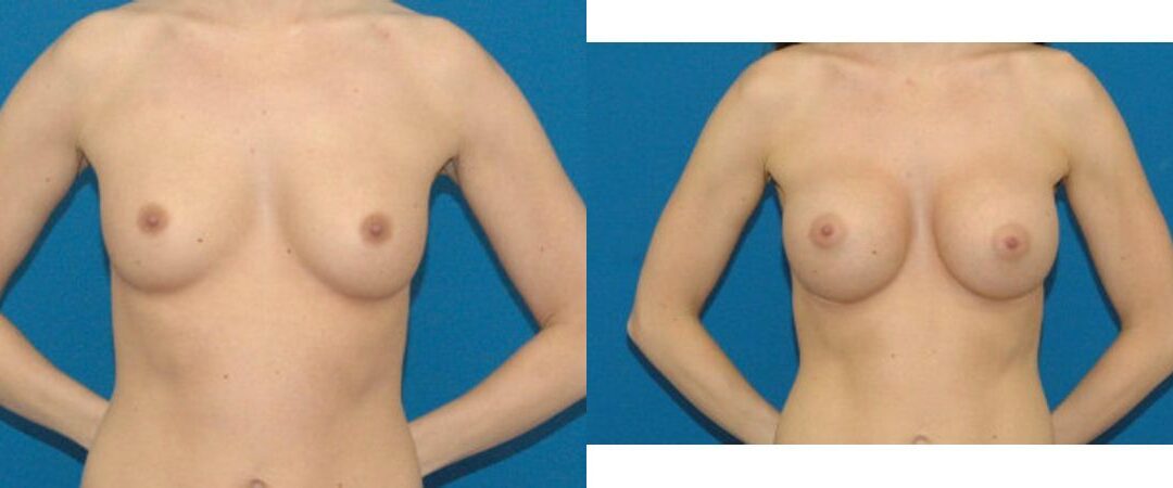 Breast Implant #79