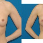 Breast Implant #79 - Before and After