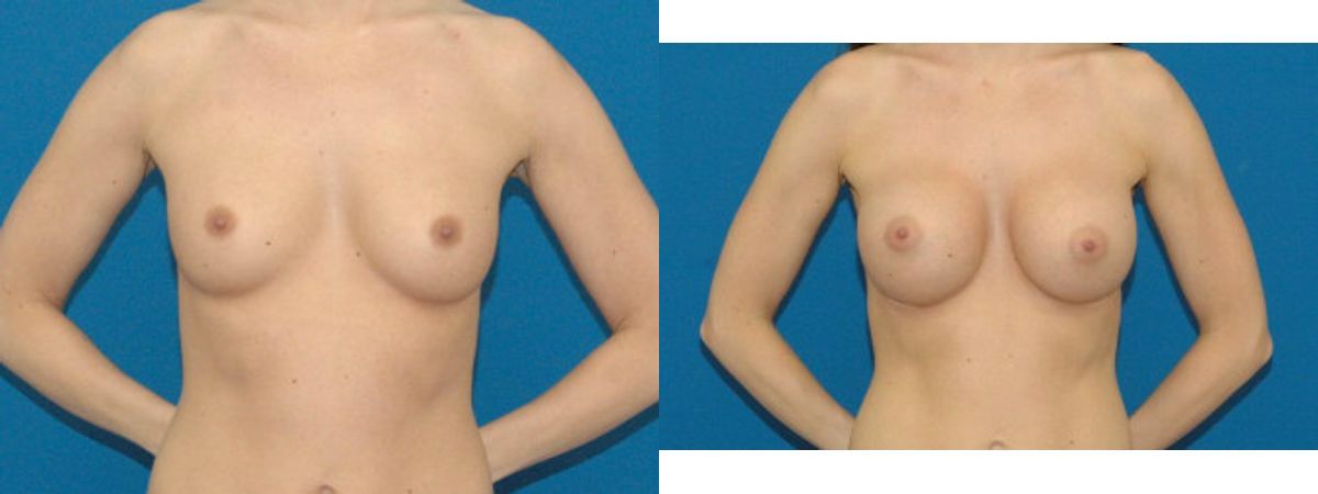 Breast Implant #79 - Before and After