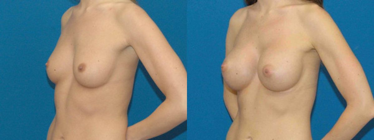 Breast Implant #79 - Before and After