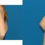 Breast Implant #79 - Before and After