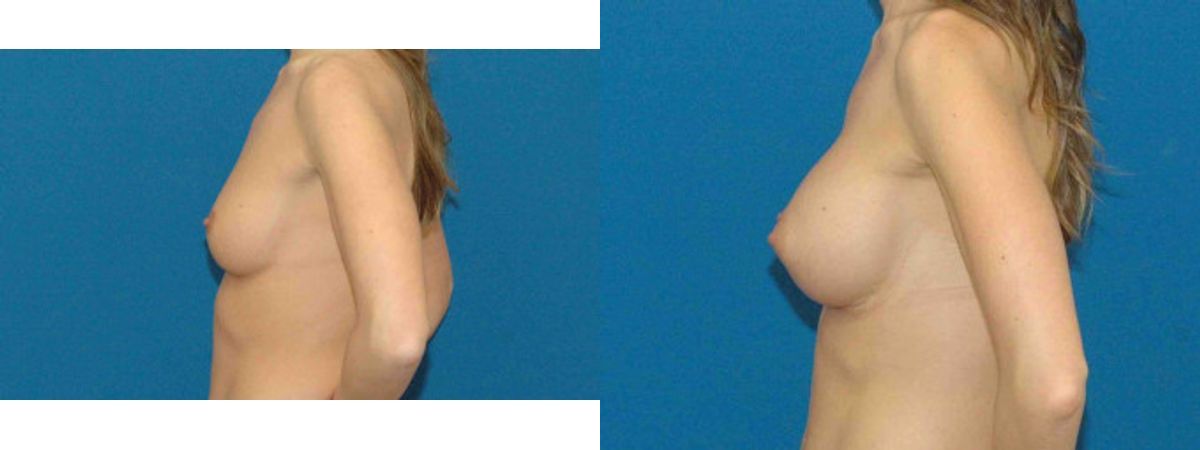 Breast Implant #79 - Before and After