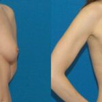 Breast Implant #79 - Before and After