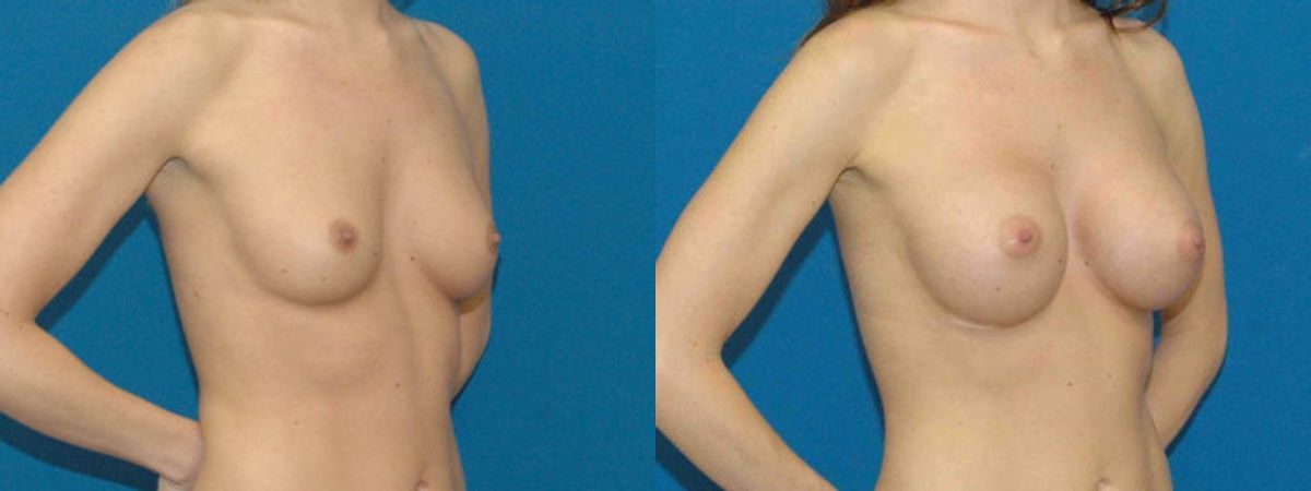 Breast Implant #79 - Before and After
