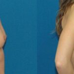 Breast Implant #79 - Before and After
