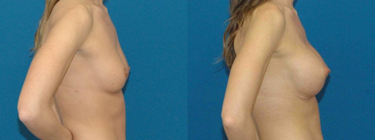 Breast Implant #79 - Before and After