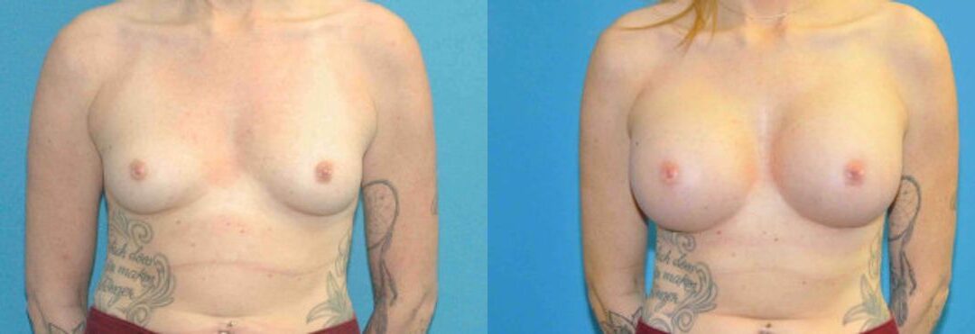 Breast Implant #80