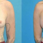Breast Implant #80 - Before and After