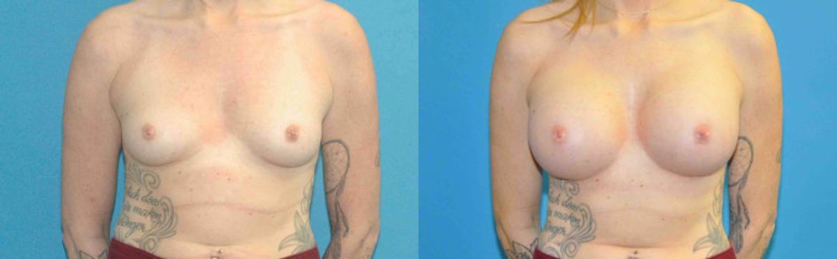 Breast Implant #80 - Before and After