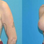 Breast Implant #80 - Before and After