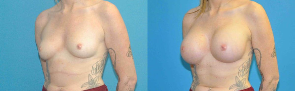 Breast Implant #80 - Before and After