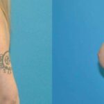 Breast Implant #80 - Before and After