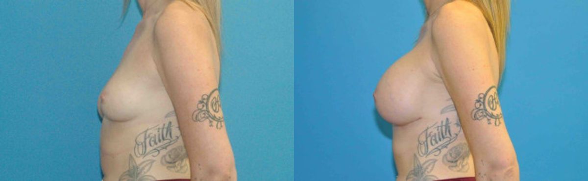Breast Implant #80 - Before and After