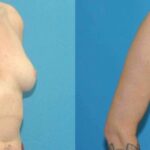 Breast Implant #80 - Before and After