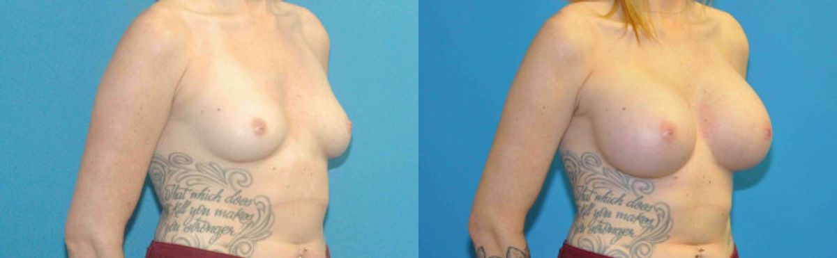 Breast Implant #80 - Before and After