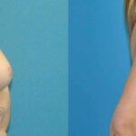 Breast Implant #80 - Before and After