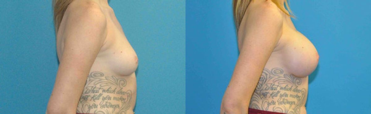 Breast Implant #80 - Before and After