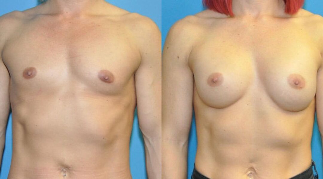 Breast Implant #81