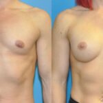 Breast Implant #81 - Before and After