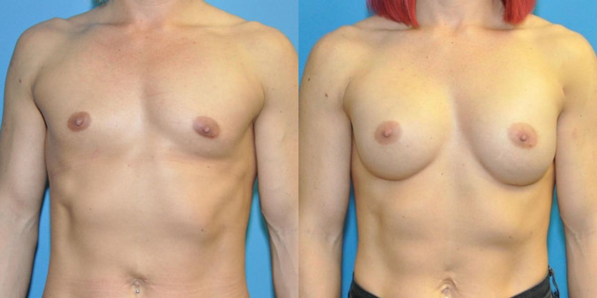 Breast Implant #81 - Before and After