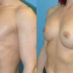 Breast Implant #81 - Before and After