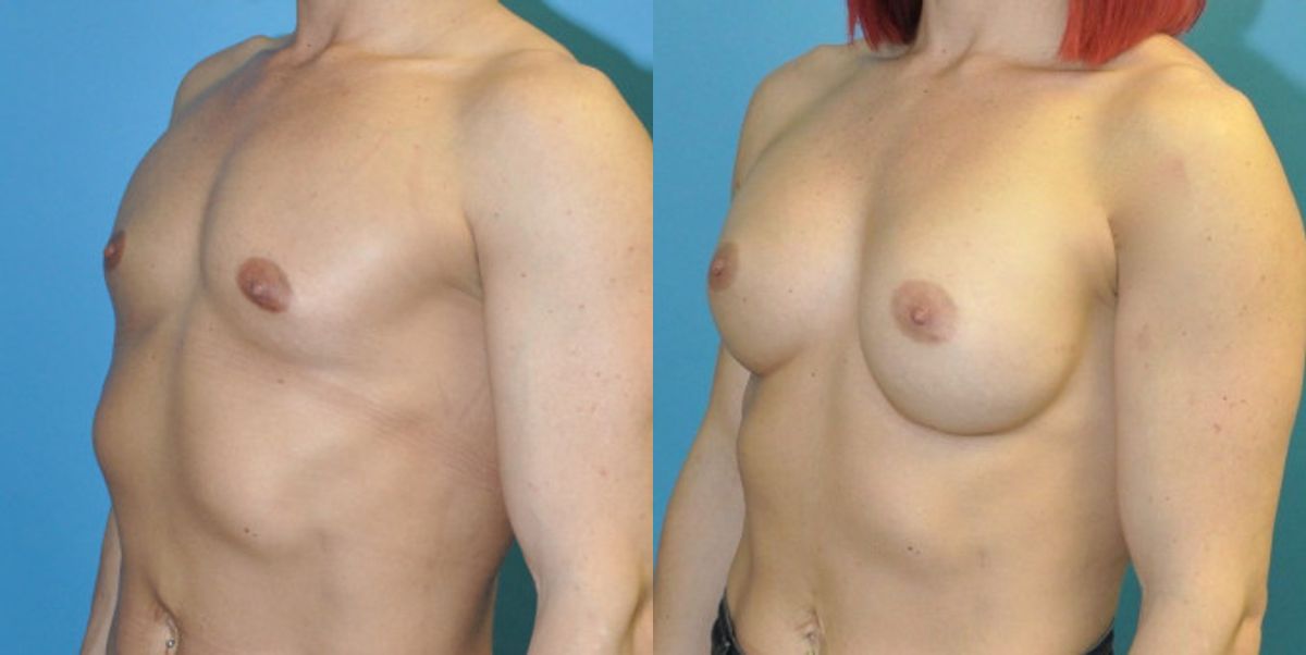 Breast Implant #81 - Before and After