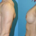 Breast Implant #81 - Before and After