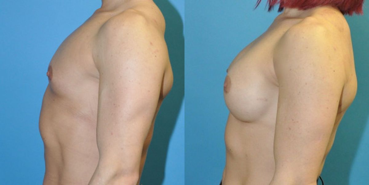 Breast Implant #81 - Before and After