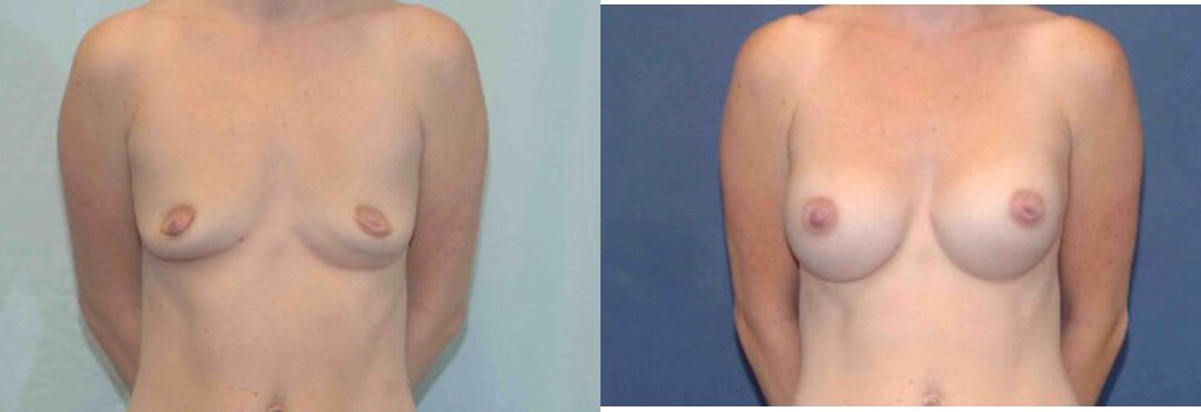 Breast Implant #82