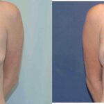 Breast Implant #82 - Before and After