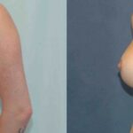 Breast Implant #82 - Before and After