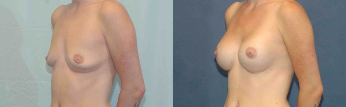 Breast Implant #82 - Before and After