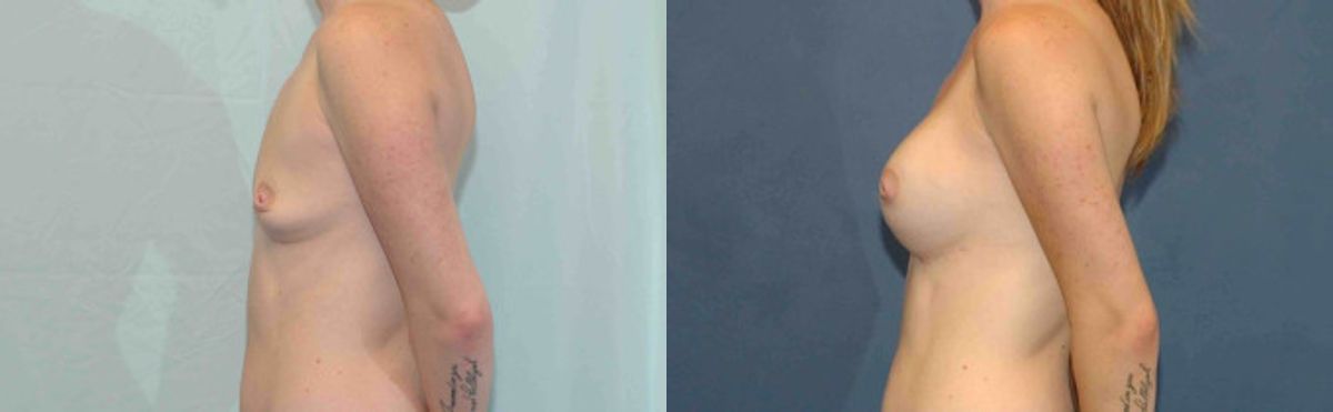 Breast Implant #82 - Before and After