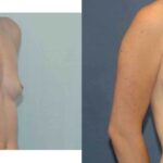 Breast Implant #82 - Before and After