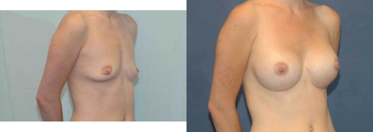 Breast Implant #82 - Before and After