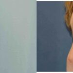 Breast Implant #82 - Before and After