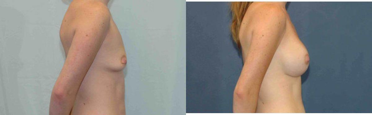 Breast Implant #82 - Before and After