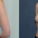 Breast Implant #83 - Before and After