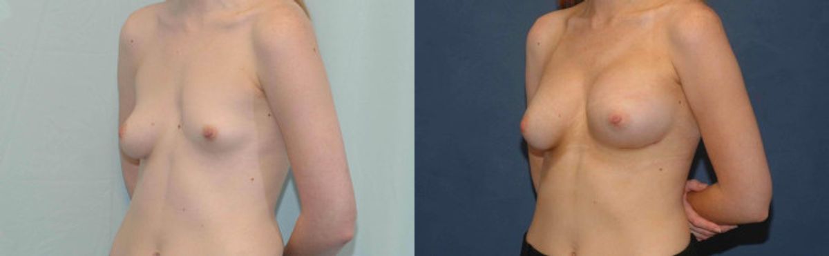 Breast Implant #83 - Before and After