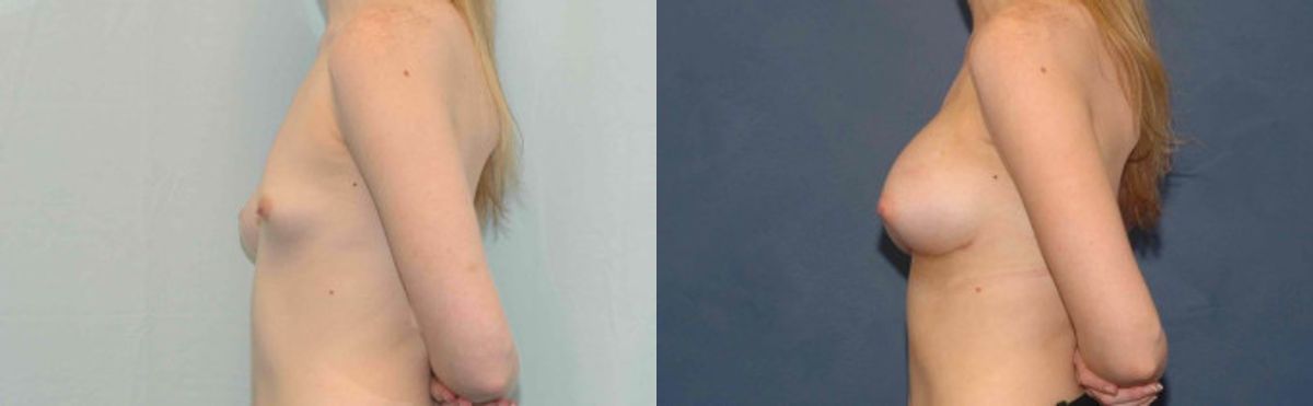 Breast Implant #83 - Before and After