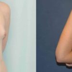 Breast Implant #83 - Before and After