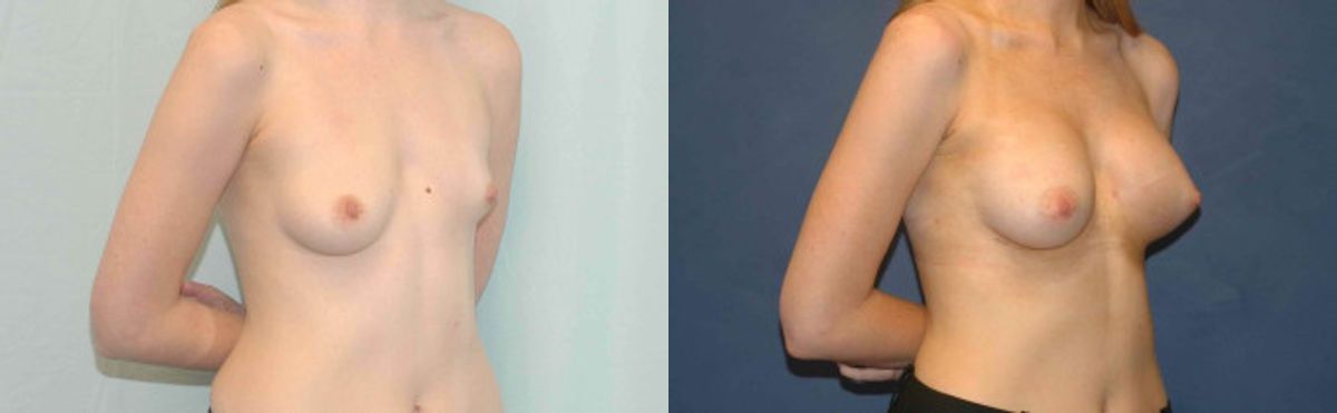Breast Implant #83 - Before and After