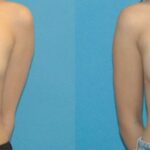 Breast Implant #84 - Before and After